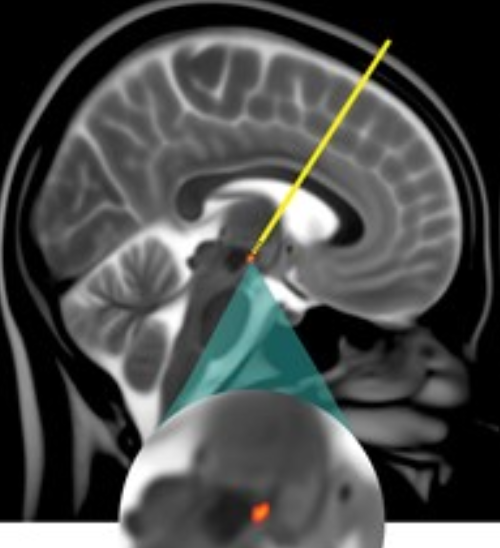 Brain stimulation reduces biases