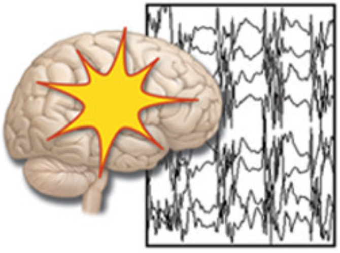 Sleep amplifies epileptics’ dementia risk